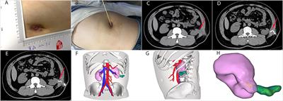Successful Postoperative Nephrocutaneous Fistula Treatment With Omental Flap Grafting: A Case Report